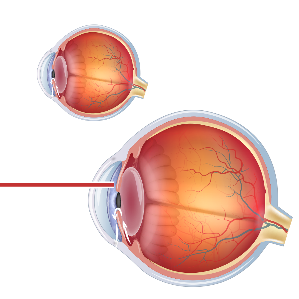 Laser peripheral iridotomy LPI