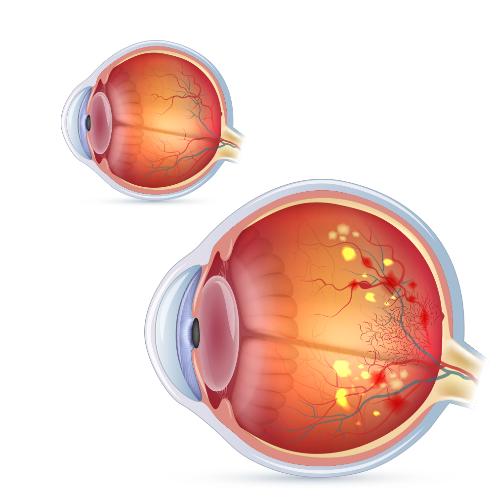 Diabetes Eyes Condition